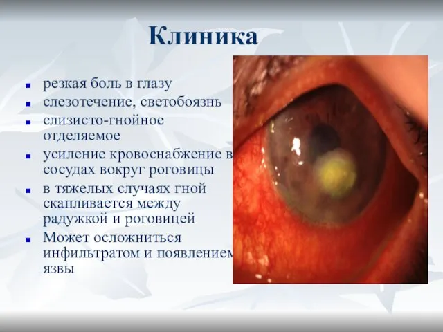 Клиника резкая боль в глазу слезотечение, светобоязнь слизисто-гнойное отделяемое усиление кровоснабжение