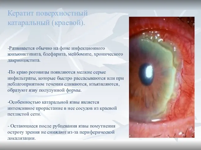 Кератит поверхностный катаральный (краевой). -Развивается обычно на фоне инфекционного конъюнктивита, блефарита,