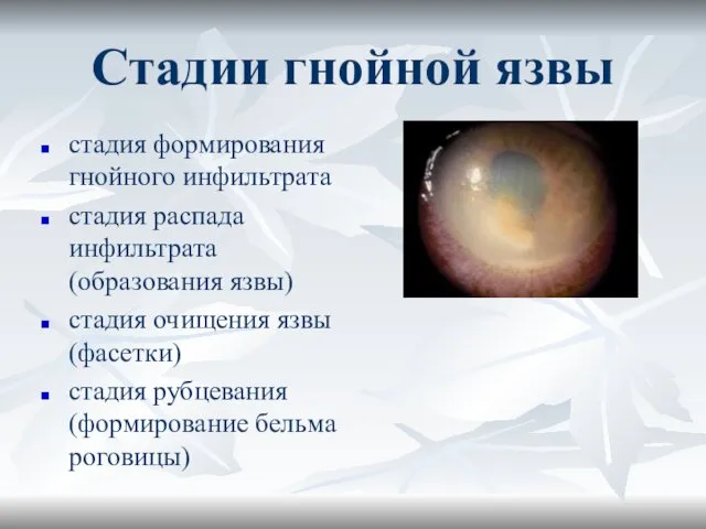 Стадии гнойной язвы стадия формирования гнойного инфильтрата стадия распада инфильтрата (образования