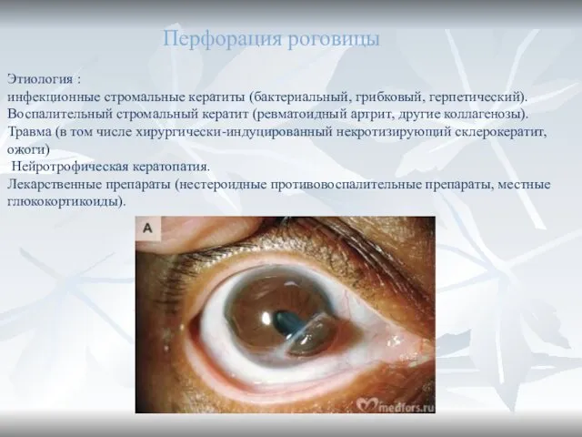 Перфорация роговицы Этиология : инфекционные стромальные кератиты (бактериальный, грибковый, герпетический). Воспалительный