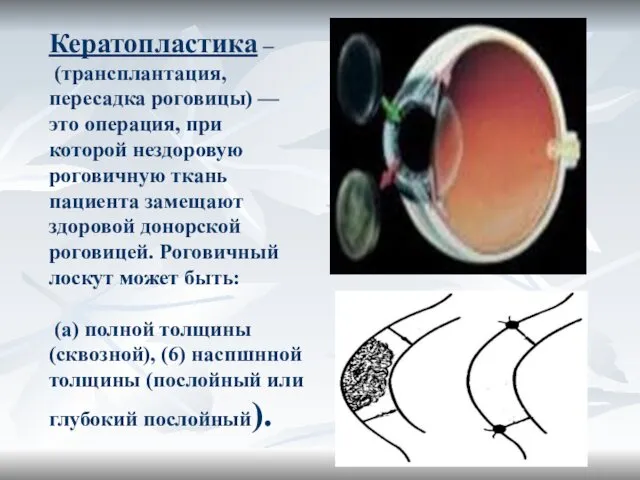 Кератопластика – (трансплантация, пересадка роговицы) — это операция, при которой нездоровую