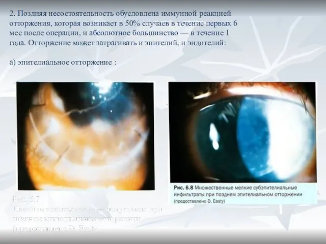 2. Поздняя несостоятельность обусловлена иммунной реакцией отторжения, которая возникает в 50%