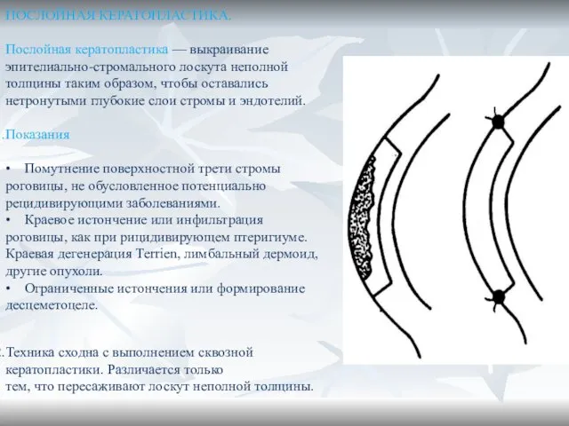 ПОСЛОЙНАЯ КЕРАТОПЛАСТИКА. Послойная кератопластика — выкраивание эпителиально-стромального лоскута неполной толщины таким