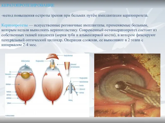 КЕРАТОПРОТЕЗИРОВАНИЕ -метод повышения остроты зрения при бельмах путём имплантации кератопротеза. Кератопротезы