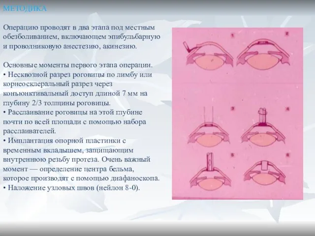 МЕТОДИКА Операцию проводят в два этапа под местным обезболиванием, включающем эпибульбарную