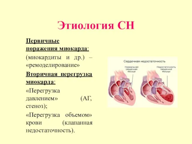 Этиология CН Первичные поражения миокарда: (миокардиты и др.) – «ремоделирование» Вторичная