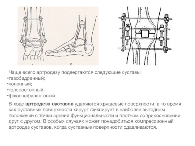 Чаще всего артродезу подвергаются следующие суставы: тазобедренный; коленный; голеностопный; флюснефаланговый. В