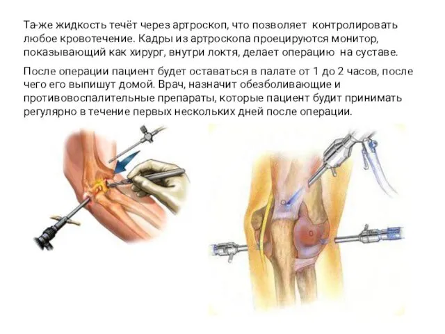 Та-же жидкость течёт через артроскоп, что позволяет контролировать любое кровотечение. Кадры