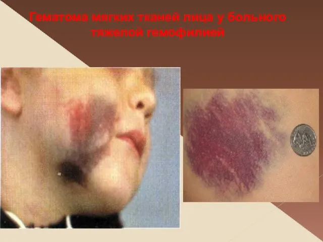 Гематома мягких тканей лица у больного тяжелой гемофилией