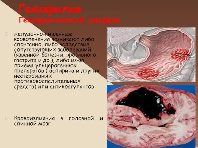 Гемофилия Геморрагический синдром желудочно-кишечные кровотечения возникают либо спонтанно, либо вследствие сопутствующих