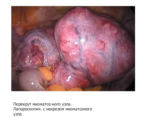 Перекрут миоматоз-ного узла. Лапароскопия. с некрозом миоматозного узла