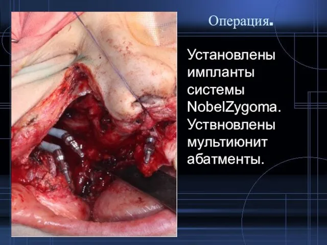 Операция. Установлены импланты системы NobelZygoma. Уствновлены мультиюнит абатменты.