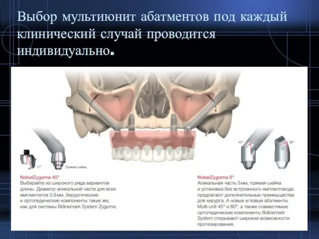 Выбор мультиюнит абатментов под каждый клинический случай проводится индивидуально.