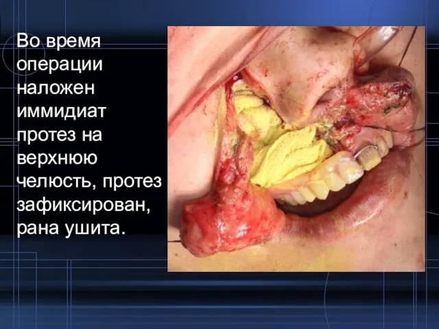 Во время операции наложен иммидиат протез на верхнюю челюсть, протез зафиксирован, рана ушита.