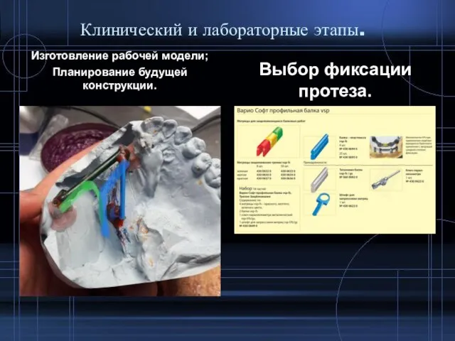 Клинический и лабораторные этапы. Изготовление рабочей модели; Планирование будущей конструкции. Выбор фиксации протеза.