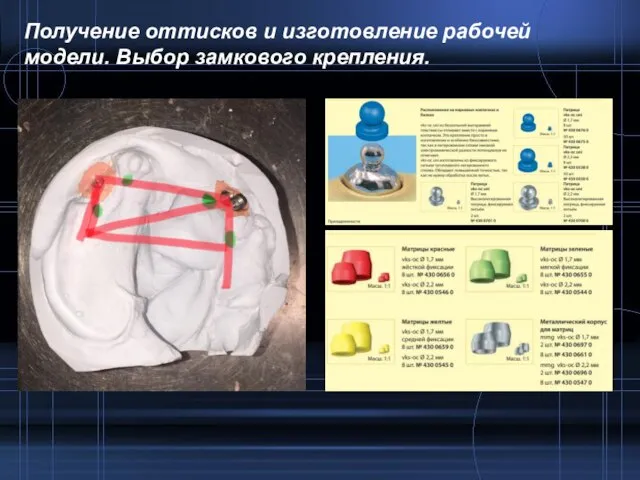 Получение оттисков и изготовление рабочей модели. Выбор замкового крепления.