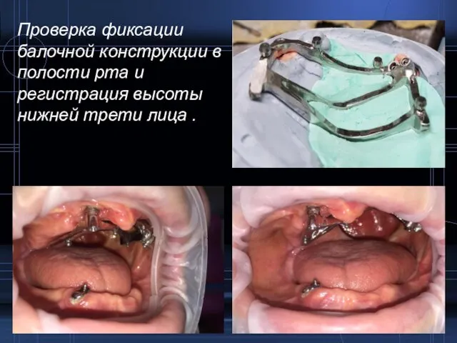 Проверка фиксации балочной конструкции в полости рта и регистрация высоты нижней трети лица .