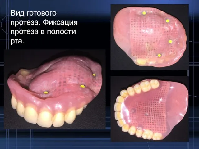 Вид готового протеза. Фиксация протеза в полости рта.