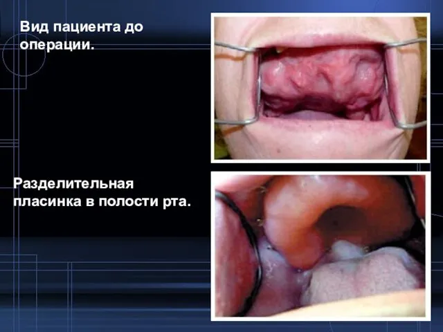 Вид пациента до операции. Разделительная пласинка в полости рта.