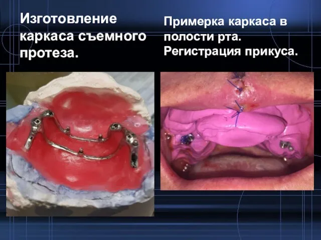 Изготовление каркаса съемного протеза. Примерка каркаса в полости рта. Регистрация прикуса.