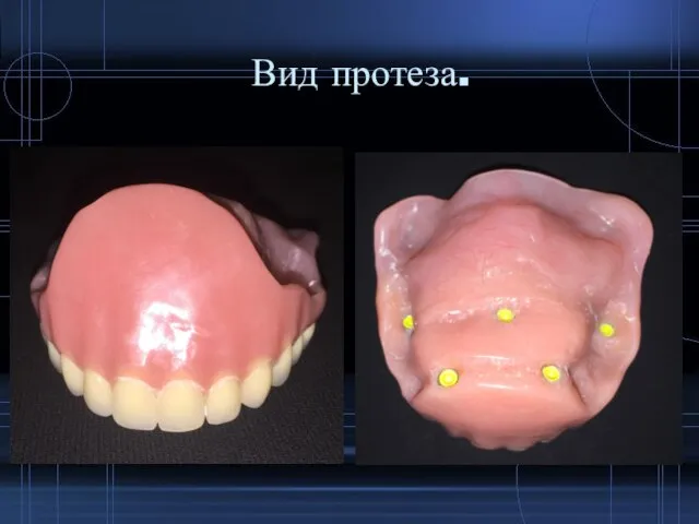 Вид протеза.