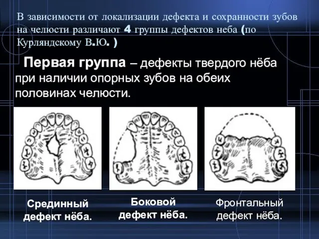 В зависимости от локализации дефекта и сохранности зубов на челюсти различают