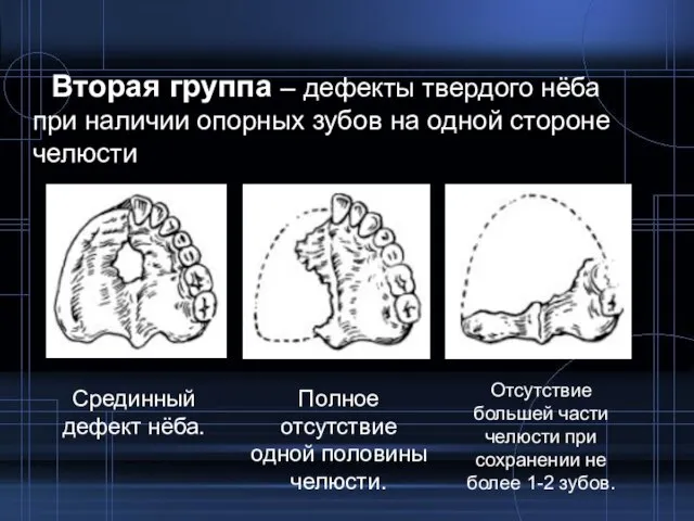 Вторая группа – дефекты твердого нёба при наличии опорных зубов на