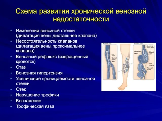 Схема развития хронической венозной недостаточности Изменения венозной стенки (дилатация вены дистальнее