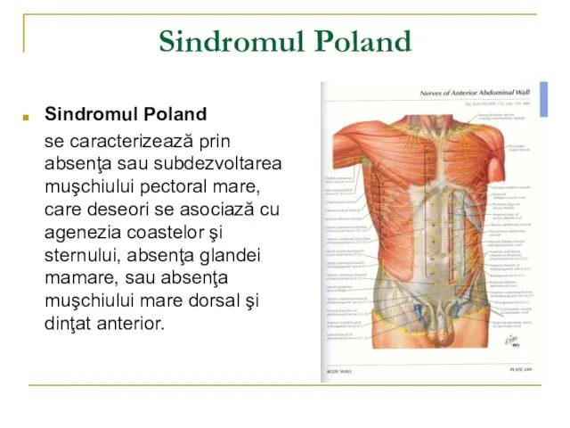 Sindromul Poland Sindromul Poland se caracterizează prin absenţa sau subdezvoltarea muşchiului