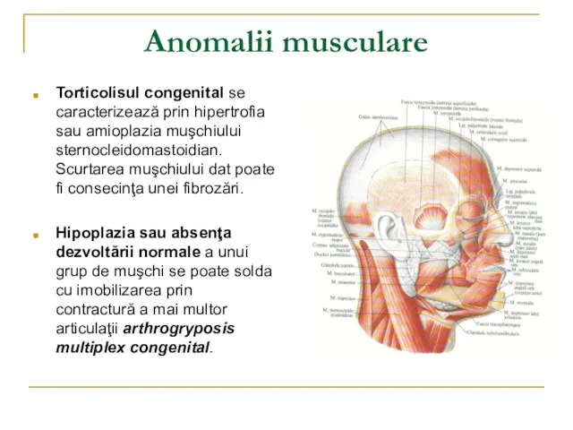 Anomalii musculare Torticolisul congenital se caracterizează prin hipertrofia sau amioplazia muşchiului