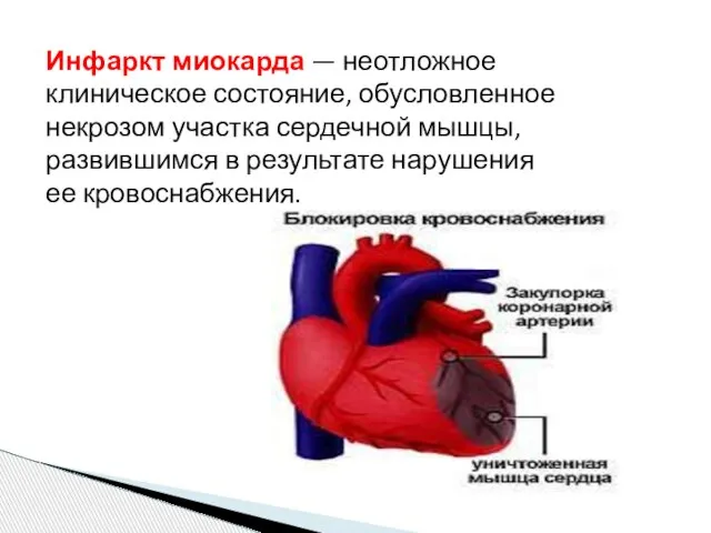 Инфаркт миокарда — неотложное клиническое состояние, обусловленное некрозом участка сердечной мышцы,