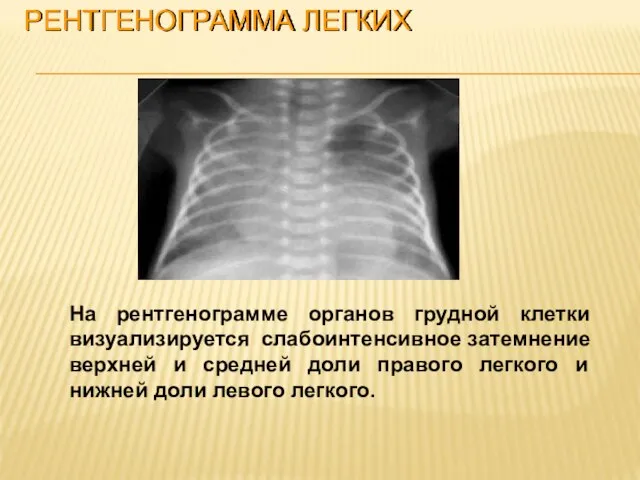 РЕНТГЕНОГРАММА ЛЕГКИХ На рентгенограмме органов грудной клетки визуализируется слабоинтенсивное затемнение верхней