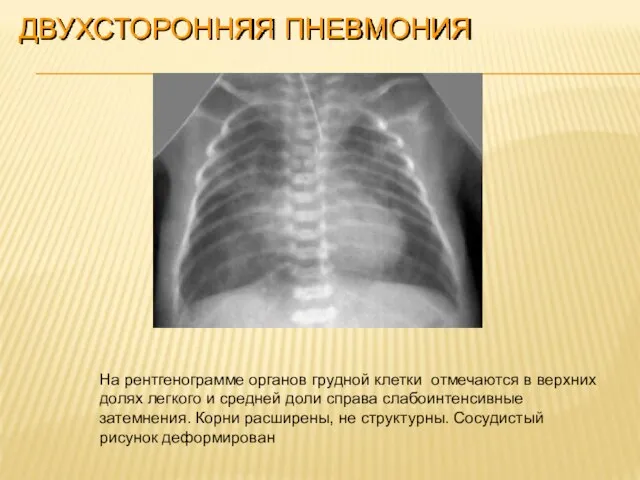ДВУХСТОРОННЯЯ ПНЕВМОНИЯ На рентгенограмме органов грудной клетки отмечаются в верхних долях