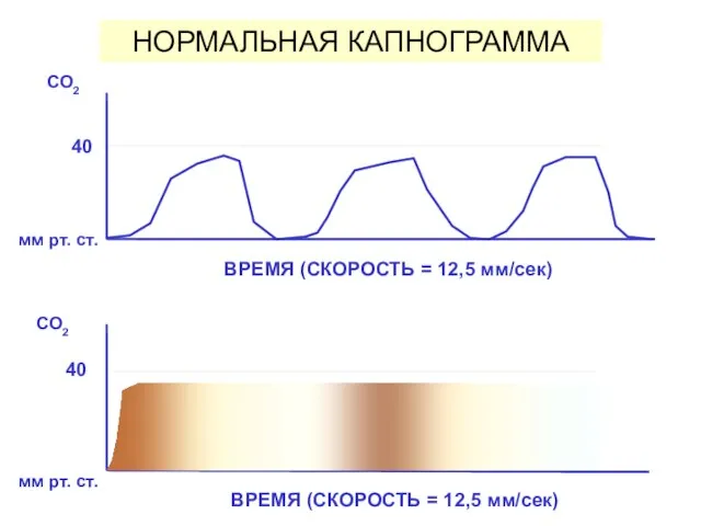 НОРМАЛЬНАЯ КАПНОГРАММА ВРЕМЯ (СКОРОСТЬ = 12,5 мм/сек)‏ мм рт. ст. CO2