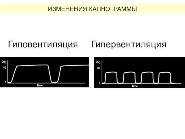 Гиповентиляция Гипервентиляция ИЗМЕНЕНИЯ КАПНОГРАММЫ