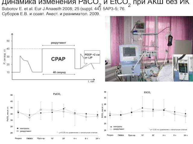 Динамика изменения PaCO2 и EtCO2 при АКШ без ИК Suborov E.