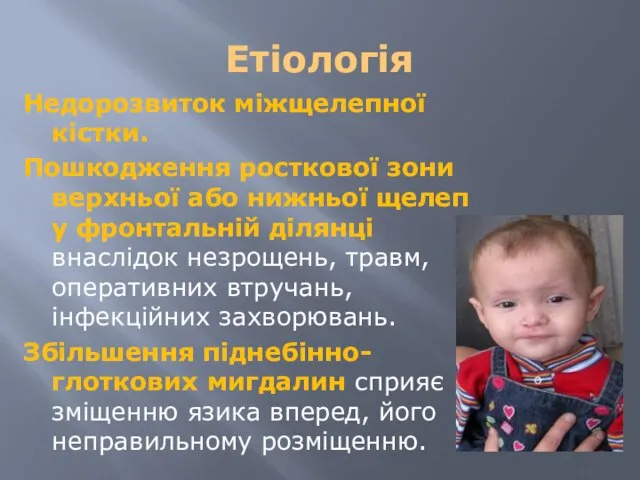 Етіологія Недорозвиток міжщелепної кістки. Пошкодження росткової зони верхньої або нижньої щелеп