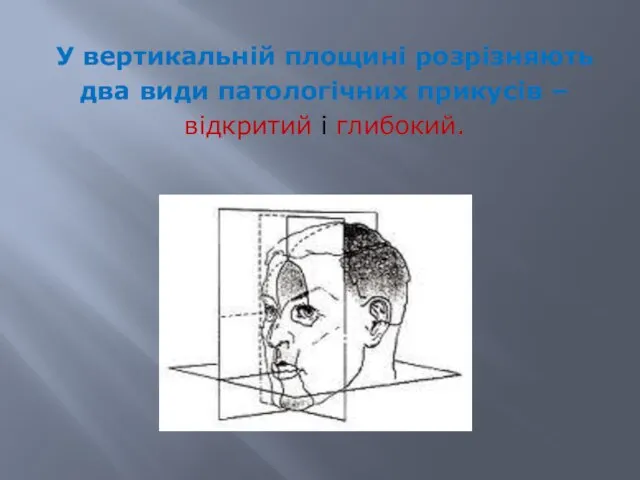У вертикальній площині розрізняють два види патологічних прикусів – відкритий і глибокий.