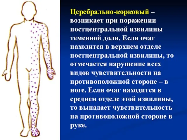 Церебрально-корковый – возникает при поражении постцентральной извилины теменной доли. Если очаг