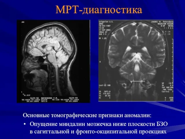 MРТ-диагностика Основные томографические признаки аномалии: Опущение миндалин мозжечка ниже плоскости БЗО в сагиттальной и фронто-окципитальной проекциях