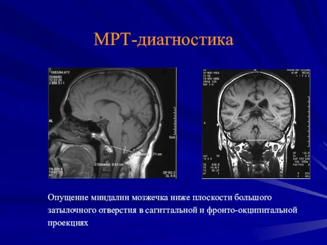 МРТ-диагностика Опущение миндалин мозжечка ниже плоскости большого затылочного отверстия в сагиттальной и фронто-окципитальной проекциях