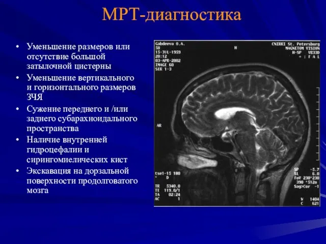 MРТ-диагностика Уменьшение размеров или отсутствие большой затылочной цистерны Уменьшение вертикального и