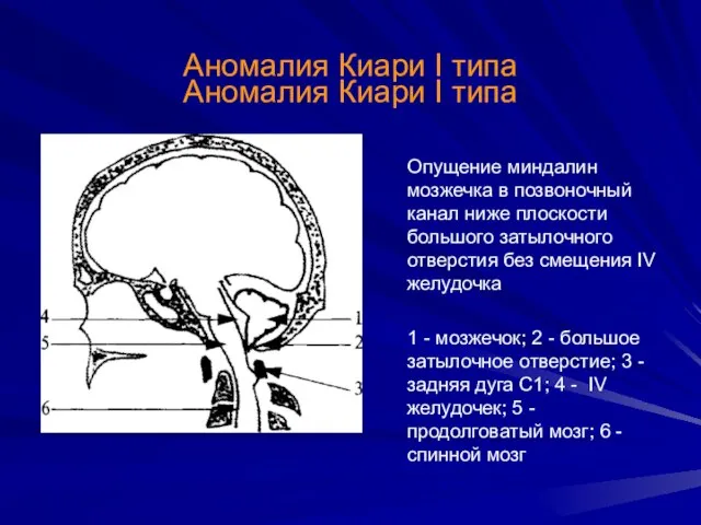 Аномалия Киари I типа Аномалия Киари I типа Опущение миндалин мозжечка