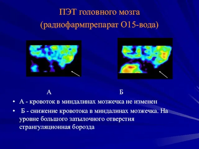 ПЭТ головного мозга (радиофармпрепарат О15-вода) А Б А - кровоток в