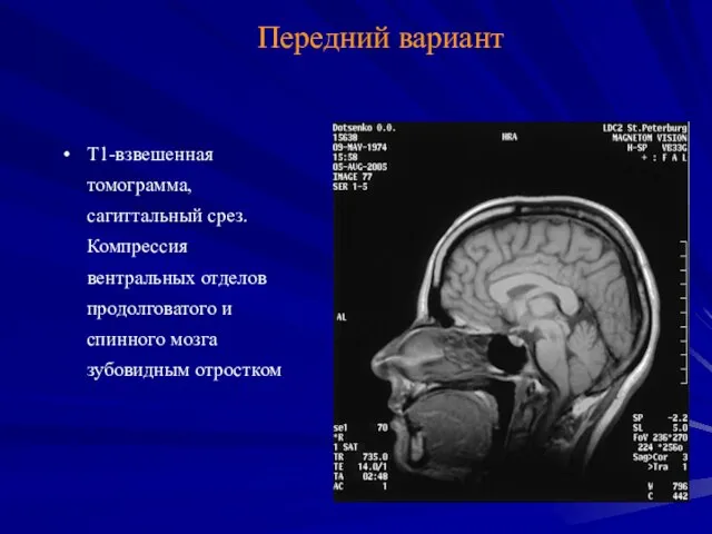 Передний вариант Т1-взвешенная томограмма, сагиттальный срез. Компрессия вентральных отделов продолговатого и спинного мозга зубовидным отростком