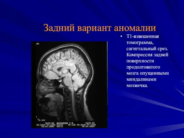 Задний вариант аномалии Т1-взвешенная томограмма, сагиттальный срез. Компрессия задней поверхности продолговатого мозга опущенными миндалинами мозжечка.