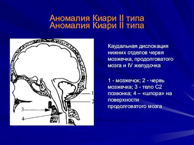 Аномалия Киари II типа Аномалия Киари II типа Каудальная дислокация нижних