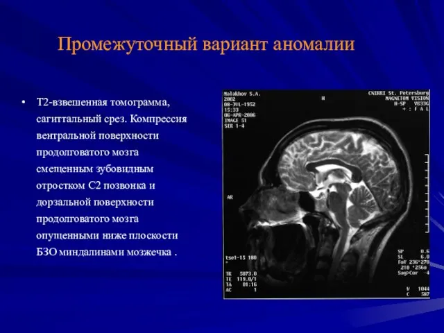 Промежуточный вариант аномалии Т2-взвешенная томограмма, сагиттальный срез. Компрессия вентральной поверхности продолговатого