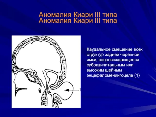 Аномалия Киари III типа Аномалия Киари III типа Каудальное смещение всех