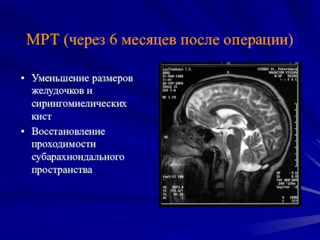 МРТ (через 6 месяцев после операции) Уменьшение размеров желудочков и сирингомиелических кист Восстановление проходимости субарахноидального пространства